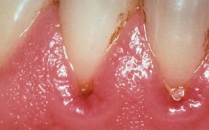 Nhiễm trùng răng miệng do bệnh đái tháo đường