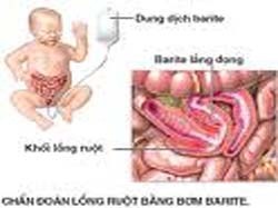 Phẫu thuật tháo lồng ruột cho bệnh nhân bị bệnh hiếm 