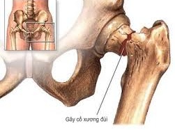 Thay khớp cho cụ bà gần 100 tuổi trong 40 phút
