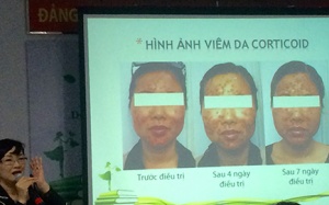 Hiểm hoạ từ công thức chế kem đẹp da có chứa corticoid