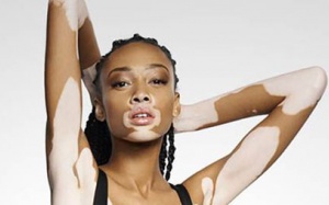 Bệnh bạch biến: Khi trên người có vùng da trắng loang lổ…