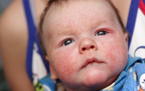 Điều trị trẻ bị chàm sữa như thế nào?