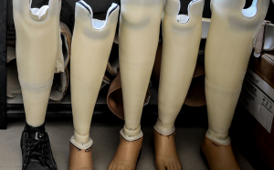 Ngày càng nhiều người bị cưa chân vì biến chứng đái tháo đường