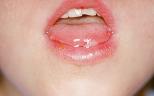 Nổi mụn trong miệng có phải bệnh tay chân miệng?