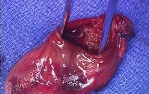 Đề phòng viêm túi mật cấp do sỏi mật