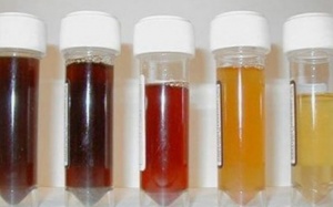 Vì sao nước tiểu sậm màu?