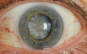 Chữa đục thuỷ tinh thể bằng thuốc… nhỏ mắt