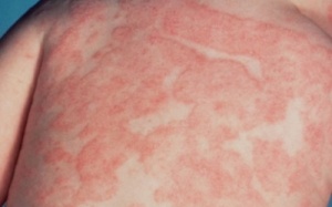 Bệnh mề đay có nguy hiểm không?