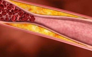 Giảm cholesterol với 10 bước đơn giản