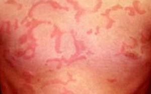 Nổi mề đay do dị ứng thức ăn