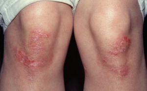 Dự phòng bệnh vẩy nến: Tuy khó mà không khó