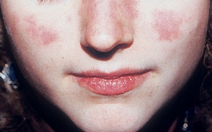 4 cách điều trị vẩy nến tại nhà