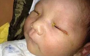 Xót xa em bé 3 tháng tuổi bị mù vì đèn flash của máy ảnh