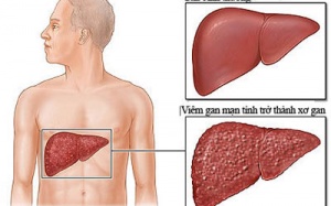 ​Mỗi năm Việt Nam có 16.000 người tử vong vì xơ gan