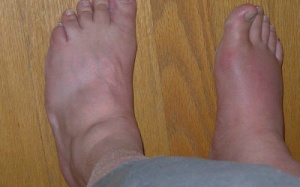 Kinh hãi với những biến chứng của gout