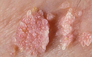 Nguy cơ biến chứng gây ung thư do mắc sùi mào gà