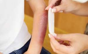 Nhiễm khuẩn vết thương, vết bỏng, chọn thuốc nào?