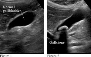 Các xét nghiệm chẩn đoán sỏi mật