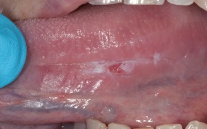 Biểu hiện ung thư lưỡi dễ bị nhầm với nhiệt miệng