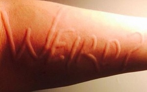 Da vẽ nổi có phải là mề đay?