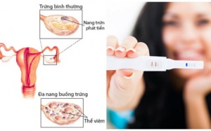 Bị buồng trứng đa nang vẫn mang thai tự nhiên được!