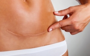 7 tuyệt chiêu 'thổi bay' sẹo lồi sau sinh cực hiệu quả