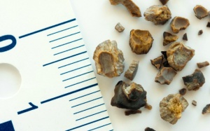 Trị sỏi thận, phòng suy thận cần tránh thực phẩm gì?