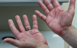 Những biện pháp tự nhiên giúp kiểm soát bệnh vẩy nến