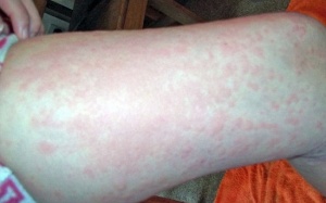 Nổi mề đay do... đi bộ, chạy bộ