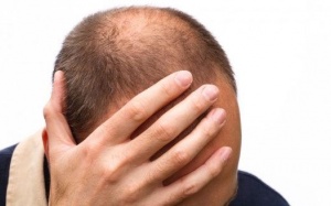 Điều trị chứng hói đầu như thế nào?