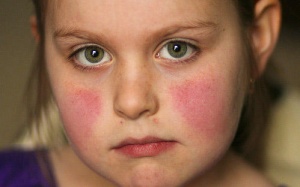 Người bị lupus ban đỏ nên và không nên ăn gì?