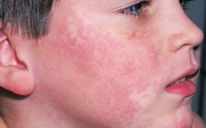 Nguyên nhân và triệu chứng của bệnh lupus ban đỏ