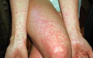 Giao tiếp, tiệc tùng khó tránh - Mề đay khó phòng