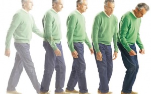 10 quan niệm “sai lè” về bệnh Parkinson