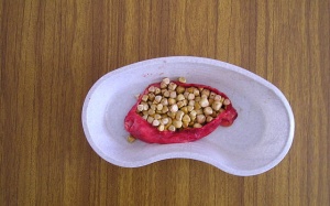 Phân biệt các loại sỏi mật