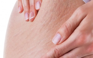 Mách bạn: Trị rạn da bằng nguyên liệu tự nhiên