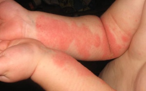 5 mẹo chăm sóc vùng da bị tổn thương do eczema