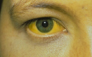 10 triệu chứng cho thấy gan có vấn đề