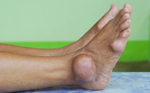 Bệnh gout – “bệnh của vua chúa” và những điều bạn nên biết