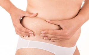 Bí quyết ngăn ngừa và xóa mờ rạn da