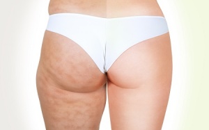 Trị da sần vỏ cam chỉ cần dầu dừa