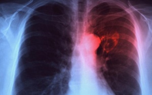 Bệnh lao giết người ngang hàng HIV/AIDS