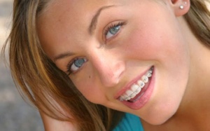 Niềng răng và những điều bạn nên biết