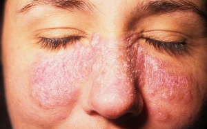 Lupus ban đỏ và những biến chứng không thể coi thường