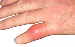 Dùng thực phẩm chức năng hỗ trợ điều trị gout có tốt không?