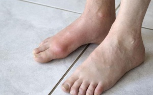Tăng nguy cơ gout vì lối sống chưa khoa học