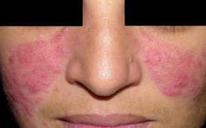 Chữa chứng đỏ mặt như thế nào?