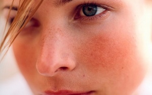 Chữa bệnh Rosacea đơn giản với biện pháp tự nhiên