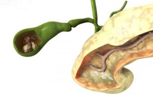 Ngăn chặn sỏi mật tận gốc