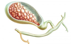 Sỏi mật không triệu trứng: Điều trị thế nào?